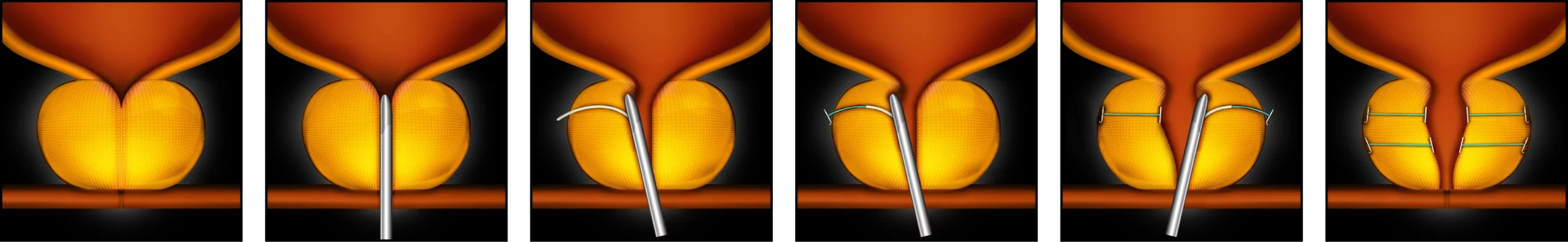 Bph Procedure Steps Illustration